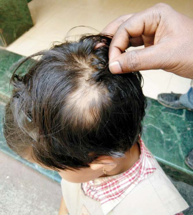 Prachi’s hair was so mercilessly pulled that she ended up with a bald patch