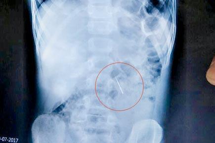 Pune: Dentist drops needle, Pimpri boy swallows it