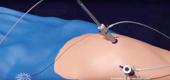 The CapnoPen is inserted in the stomach, and is directed towards the tumour. The chemotherapy solution is then sprayed directly on the cancerous area