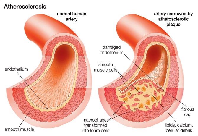 Atherosclerosis: Comparison of a normal artery with an artery narrowed by atherosclerotic plaque. (Photo By Encyclopaedia Britannica/UIG Via Getty Images)