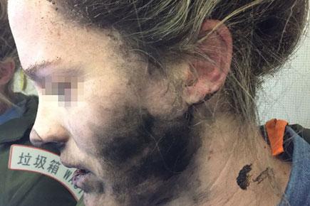 Woman's face burned after headphones explode on flight