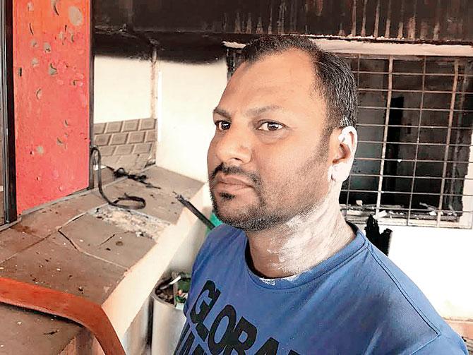 Raju Decorator has suffered 40 per cent burns