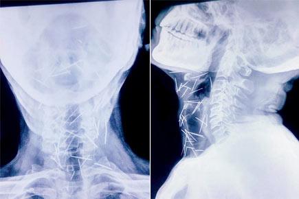 Mumbai: Rajasthan man clueless about how 75 pins got inside his body