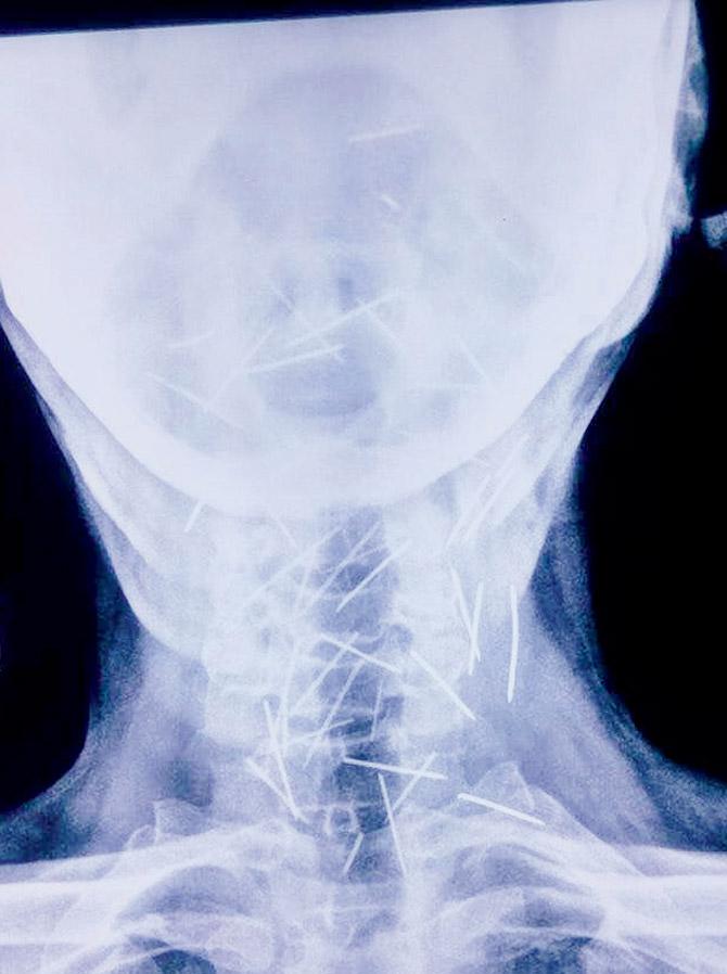 X-ray of Meena