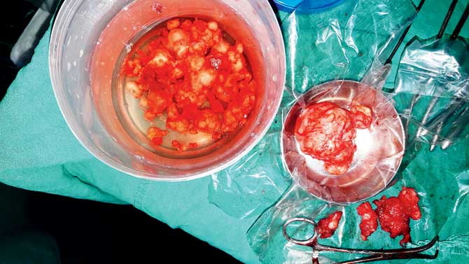 The fibroids removed from Reshma