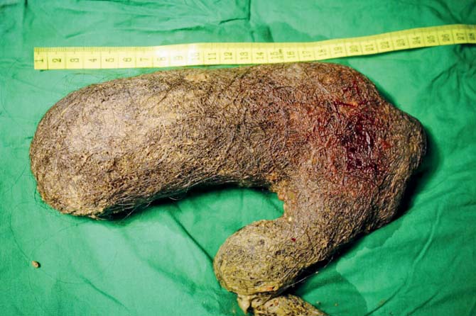 Because of the size of the hairball, doctors suspect that the patient had been eating her hair for years