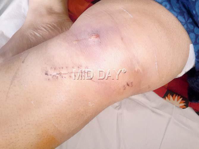 Uma Iyer has alleged that KEM hospital doctors closed the incision with just stitches, which led to the infection in her leg. Pic/Sneha Kharabe