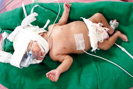 Palm-sized 'baby' fights for life as Mira Road couple struggles for funds