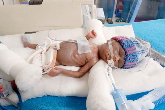 Baby had an extremely weak lung and under-developed organs at the time of birth