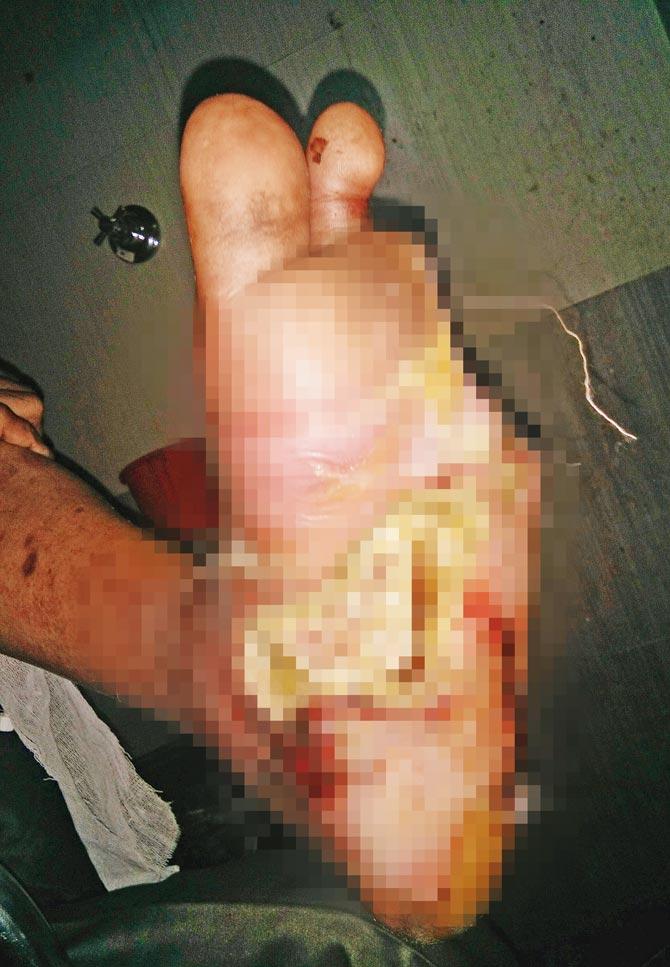 Three fingers had to be amputated from Pradeep Raut