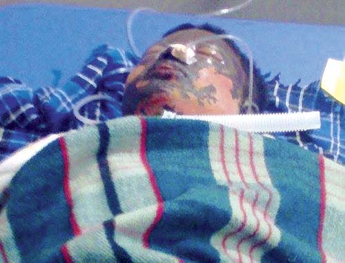 Teenager gets a 25,000-volt shock in an attempt to take a selfie: On January 6, 2015. 16-year-old Ganesh Kumkumawati sustained 90 per cent burns after he accidentally touched a 25,000-volt overhead wire at the Jogeshwari railway yard. Ganesh was trying to click a rooftop selfie when he got electrocuted. Ganesh was reportedly taking a photograph of himself atop the compartment of a standing train when he accidentally touched the overhead wire, which had 25,000 volts of current coursing through it. The boy sustained 90% burn injuries and was battling for his life.      