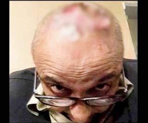 Syed Sajid Hasan shares video of how his hair transplant went awry
