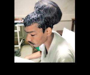 Mumbai: Nair Hospital doctors remove tumour weighing 1.8 kg from man's head