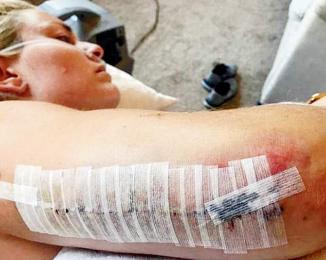 Vonn in hospital with a broken arm immediately after her  crash during training in 2016