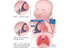 Timely procedure saves infant's life who was born with rare lung disease