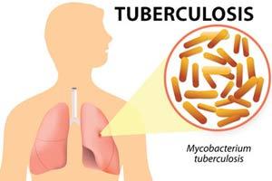 World TB day: 11% increase in drug-resistant tuberculosis cases, say BMC data