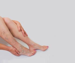 Varicose veins may increase risk of blood clots
