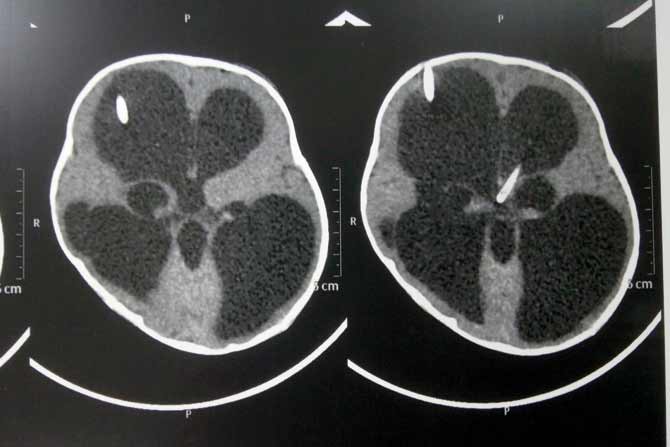 A CT scan done at Cooper hospital shows the floating Ommaya catheter left accidentally by KEM staff. Pic/Sayyed Sameer Abedi