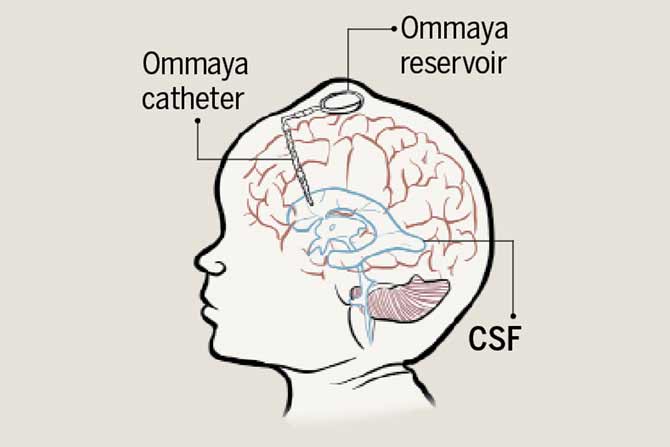 CT Scan