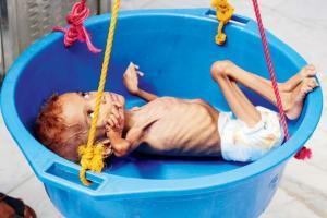 Starvation and disease kill 85,000 infants in Yemen