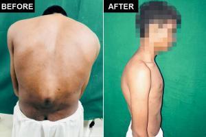 Mumbai: Teen to 'sit' for exams after rare spinal condition surgery