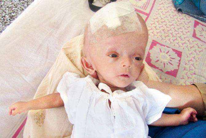 Baby Eliza needs a second surgery to relieve the excess cerebrospinal fluid trapped in her head