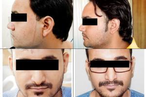  Doctor develops new technique, uses botox to heal facial scars