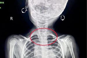 Mumbai: Child swallows safety pin hung around mother's mangalsutra