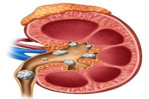 Kidney stones partially dissolve naturally: Study
