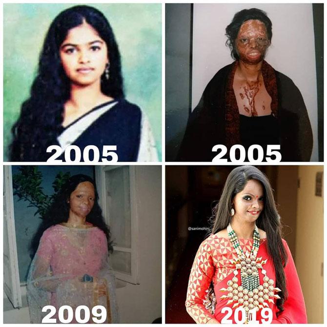 Laxmi Agarwal fights for the rights of acid attack victims. She has inspired thousands of people and has become the voice of acid attack survivors in India. Laxmi is regarded as one of the pioneers for the upliftment and empowerment of the rights of acid attack survivors in India