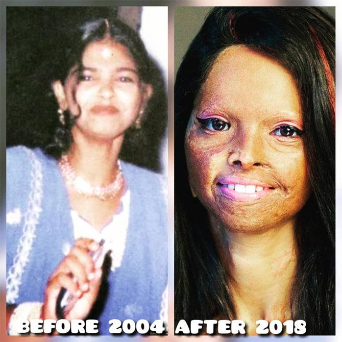 Laxmi Agarwal gave tips on how to not talk to an acid survivor and that one should never victimise a survivor. She said that the problem lies in the fact that after somebody is attacked, the first question which comes to the minds of the people is, 