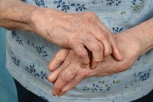 Intimate relationships of people with inflammatory arthritis is affected