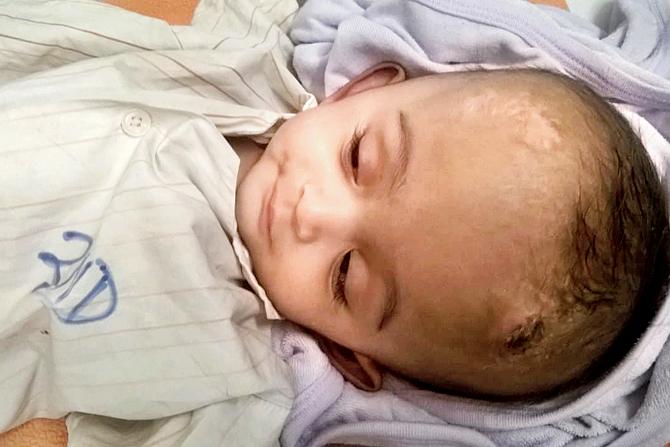 Baby Eliza before the surgery