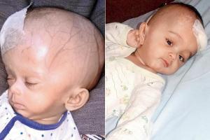 Baby Eliza's surgery successful; size of her head reduced by four cms