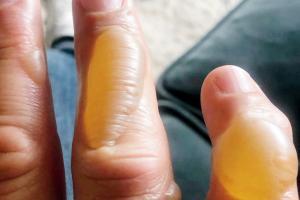 Cook and former footballer Gary Lineker burns his fingers