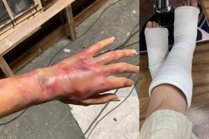 Taapsee Pannu posts photo of bruised hand, fans get worried