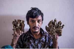This man suffers from rare disorder making him turn into a tree