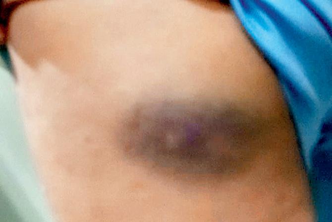 The bruise that Deepali Shinde allegedly sustained in the caning