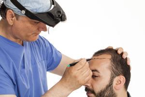 Things to know about Hair Transplant