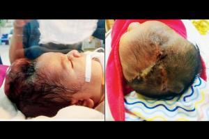 Surgeons from Santacruz hospital save 2-day-old with 'invisible' lesion