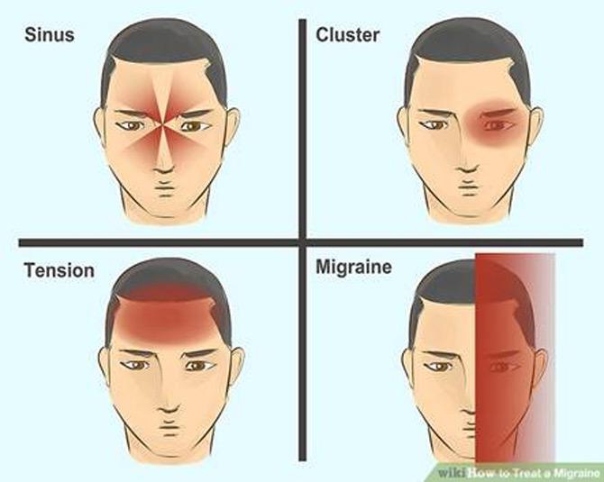 Migraine Infographic