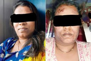 Mumbai: Doctor in the dock for burning woman's face in Dahisar