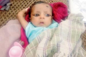 After burns, two-month-old baby loses arm, may also lose ear