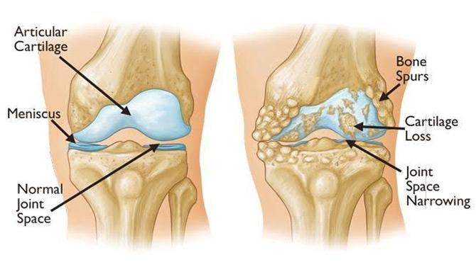 Ankit-Osteoarthritis