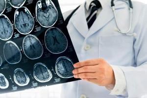 COVID-19 infection linked to stroke in healthy young people: Study