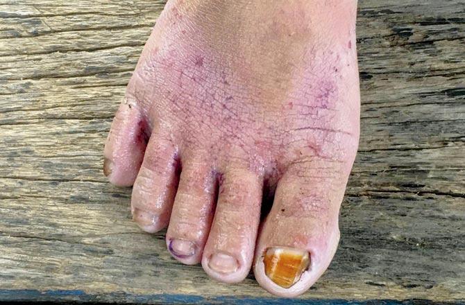 A woman who sprays pesticides displays the raw, irritated skin on her foot and damaged toenails she blames on the chemicals, in Sumatra. Pics/AP