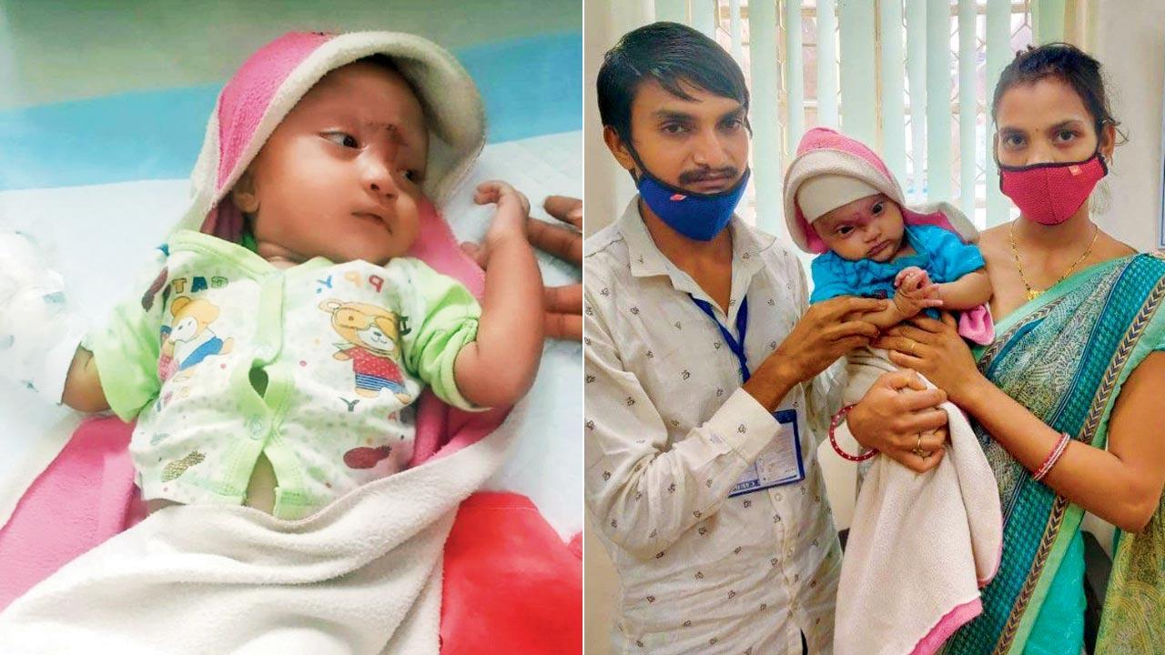 Mumbai: Baby with brain sac hanging over his face has complex surgery