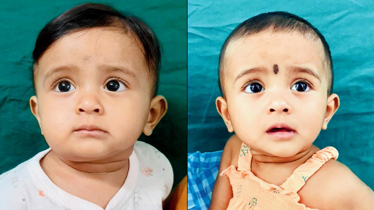 Mumbai: Wadia doctors use a piece of leg bone to fix infant’s jaw