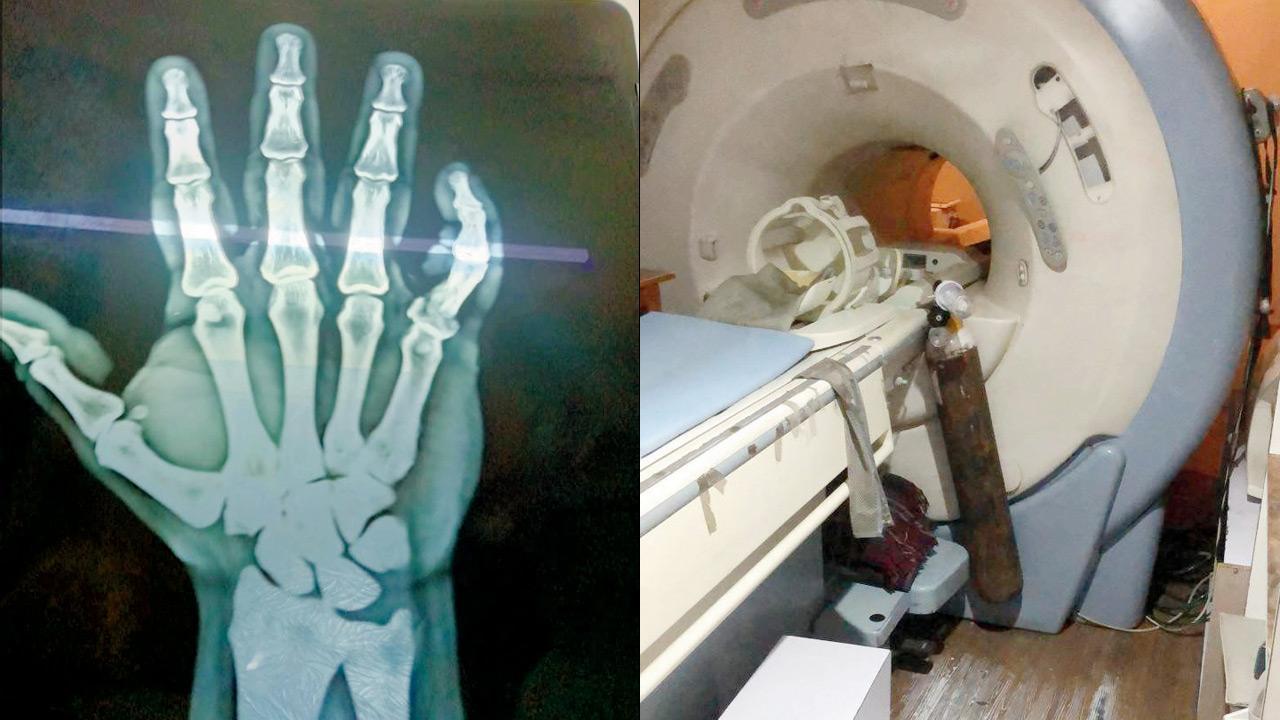Mumbai: Man sucked in by MRI machine gets away with just a broken finger