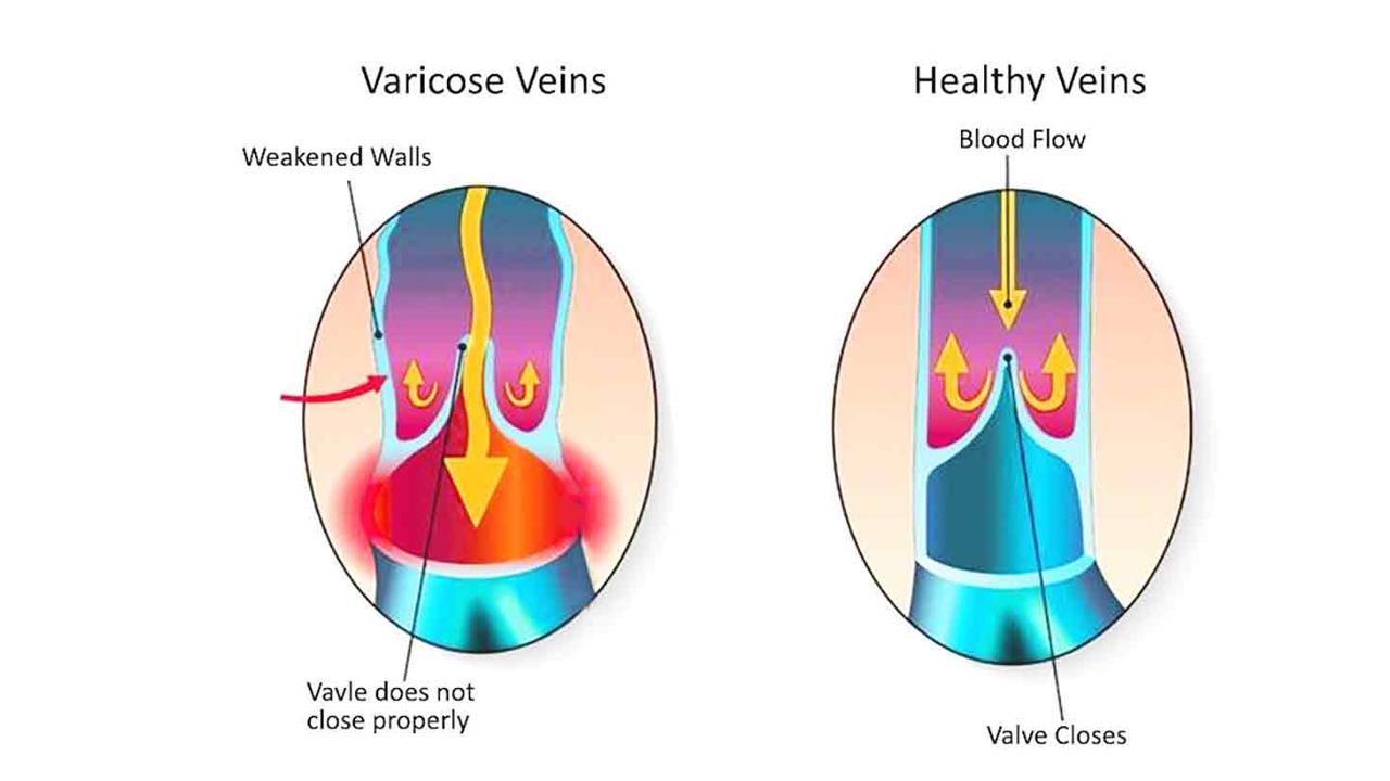 Venaseal Closure System for Varicose Veins Treatment